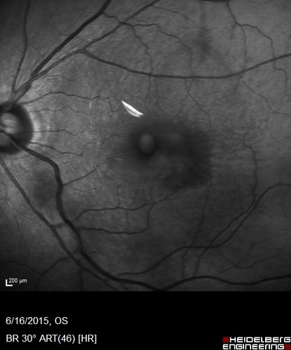 New wet AMD OS with subretinal hemorrhage and recent vision loss, Scar OD
