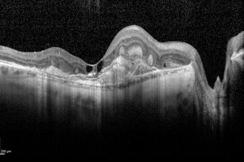 New wet AMD OS with subretinal hemorrhage and recent vision loss, Scar OD
