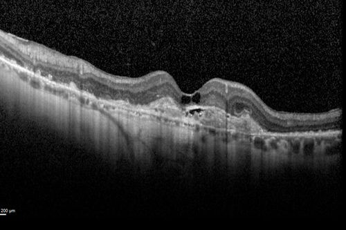 New wet AMD OS with subretinal hemorrhage and recent vision loss, Scar OD
