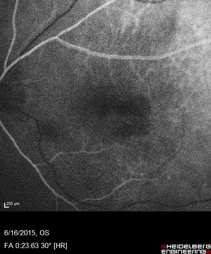 New wet AMD OS with subretinal hemorrhage and recent vision loss, Scar OD
