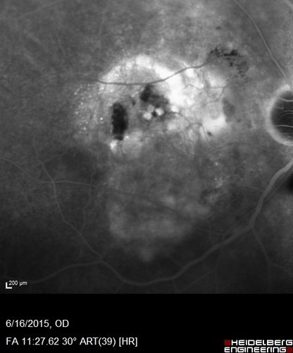 New wet AMD OS with subretinal hemorrhage and recent vision loss, Scar OD
