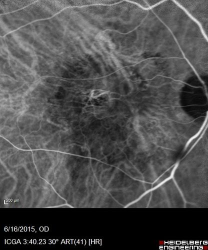 New wet AMD OS with subretinal hemorrhage and recent vision loss, Scar OD
