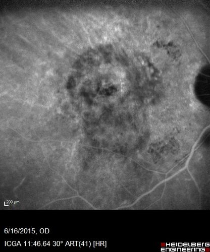 New wet AMD OS with subretinal hemorrhage and recent vision loss, Scar OD
