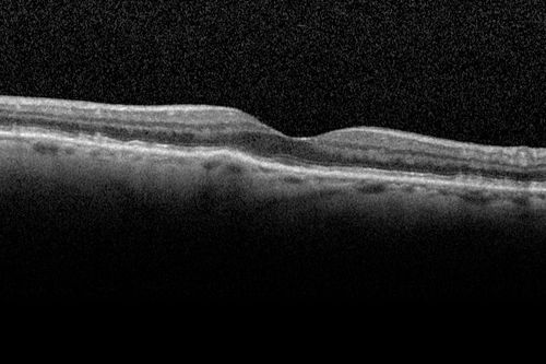 Wet AMD 1 month after Eylea - macula is dry and vision is better
