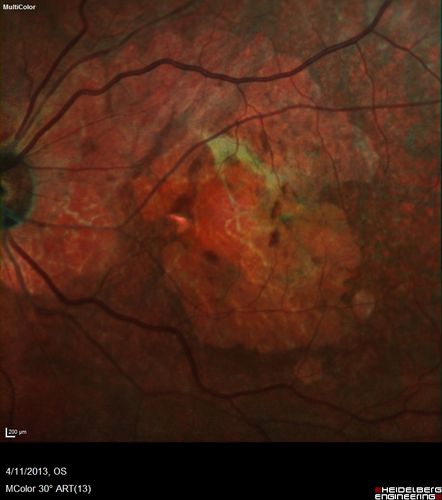 Macular Atrophy - Phototoxicity - Macular Hole Surgery - False color
25 years ago patient suffered immediate severe vision loss following macular hole surgery.  You can almost see light pipe tracks in the atrophy in the macula.  Vision is 5/200
