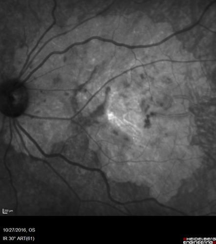 Macular Atrophy - Phototoxicity - Macular Hole Surgery
25 years ago patient suffered immediate severe vision loss following macular hole surgery.  You can almost see light pipe tracks in the atrophy in the macula.  Vision is 5/200
