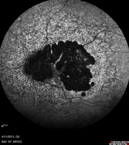 Macular Atrophy - Phototoxicity - Macular Hole Surgery - FAF image
25 years ago patient suffered immediate severe vision loss following macular hole surgery.  You can almost see light pipe tracks in the atrophy in the macula.  Vision is 5/200
