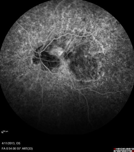 Macular Atrophy - Phototoxicity - Macular Hole Surgery
25 years ago patient suffered immediate severe vision loss following macular hole surgery.  You can almost see light pipe tracks in the atrophy in the macula.  Vision is 5/200

