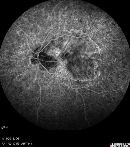 Macular Atrophy - Phototoxicity - Macular Hole Surgery
25 years ago patient suffered immediate severe vision loss following macular hole surgery.  You can almost see light pipe tracks in the atrophy in the macula.  Vision is 5/200
