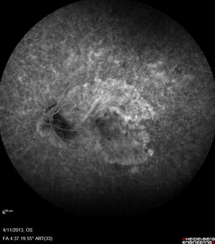 Macular Atrophy - Phototoxicity - Macular Hole Surgery
25 years ago patient suffered immediate severe vision loss following macular hole surgery.  You can almost see light pipe tracks in the atrophy in the macula.  Vision is 5/200
