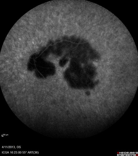 Macular Atrophy - Phototoxicity - Macular Hole Surgery - Late ICG image
25 years ago patient suffered immediate severe vision loss following macular hole surgery.  You can almost see light pipe tracks in the atrophy in the macula.  Vision is 5/200

