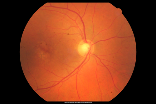 Macular Telangiectasia and dry AMD - Simulating wet AMD
This patient was told different things by different retina specialists.  Her case is complex because she has OCT findings of Macular Telangiectasis and dry AMD.  This makes it look like she has wet AMD.  Her vision is stable.
