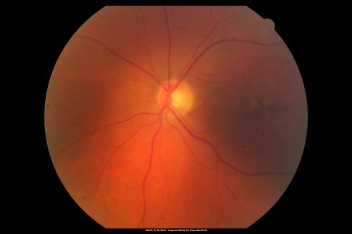 Macular Telangiectasia and dry AMD - Simulating wet AMD
This patient was told different things by different retina specialists.  Her case is complex because she has OCT findings of Macular Telangiectasis and dry AMD.  This makes it look like she has wet AMD.  Her vision is stable.
