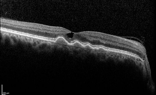 Macular Telangiectasia and dry AMD - Simulating wet AMD
This patient was told different things by different retina specialists.  Her case is complex because she has OCT findings of Macular Telangiectasis and dry AMD.  This makes it look like she has wet AMD.  Her vision is stable.
