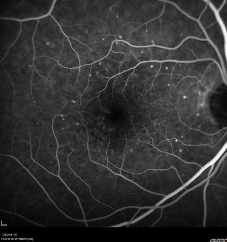 Macular Telangiectasia and dry AMD - Simulating wet AMD
This patient was told different things by different retina specialists.  Her case is complex because she has OCT findings of Macular Telangiectasis and dry AMD.  This makes it look like she has wet AMD.  Her vision is stable.
