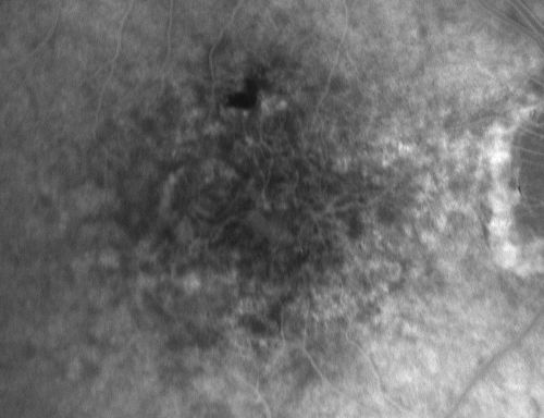 Vision Loss, Blood, and Cartwheel CNVM OD with no fluid on OCT Scan
86-year-old man has had changing vision.  He says his vision has been gradually declining since I saw him in June.  You saw a hemorrhage in the eye and suggested he comes in here for an evaluation.  He is on Combigan and Travatan in the right eye for his glaucoma.

VISUAL ACUITY:  Vision OD is 6/200 OS is 8/200 The  macula in the right eye is wet even though interestingly the OCT does not show subretinal fluid.
