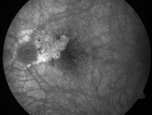 Vision Loss, Blood, and Cartwheel CNVM OD with no fluid on OCT Scan
86-year-old man has had changing vision.  He says his vision has been gradually declining since I saw him in June.  You saw a hemorrhage in the eye and suggested he comes in here for an evaluation.  He is on Combigan and Travatan in the right eye for his glaucoma.

VISUAL ACUITY:  Vision OD is 6/200 OS is 8/200 The  macula in the right eye is wet even though interestingly the OCT does not show subretinal fluid.
