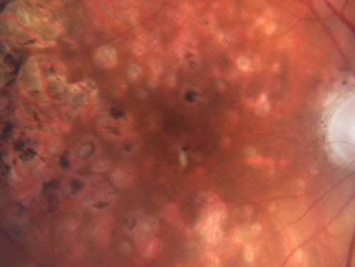 Macular and Peripheral Retinal Scarring from Diabetic Laser Done 25 years previously
72-year-old man had macular and peripheral laser done in the past(1980's)(25 years ago).  His vision, although limited, seems about stable to him.  He is diabetic for 30 years. OD is 20/160, OS  is 20/160.
