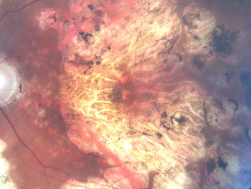 Macular and Peripheral Retinal Scarring from Diabetic Laser Done 25 years previously
72-year-old man had macular and peripheral laser done in the past(1980's)(25 years ago).  His vision, although limited, seems about stable to him.  He is diabetic for 30 years. OD is 20/160, OS  is 20/160.
