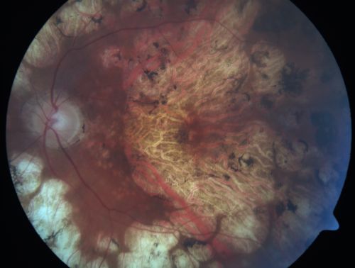 Macular and Peripheral Retinal Scarring from Diabetic Laser Done 25 years previously
72-year-old man had macular and peripheral laser done in the past(1980's)(25 years ago).  His vision, although limited, seems about stable to him.  He is diabetic for 30 years. OD is 20/160, OS  is 20/160.
