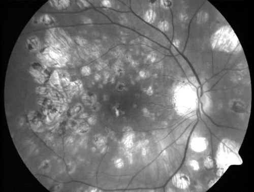 Macular Atrophy - Macular Degeneration and Previous Diabetic Macular Laser 72 Year Old Man
72-year-old man has age-related macular degeneration who had macular and peripheral laser done 30 years ago for diabetic retinopathy.  He has developed worsening macular atrophy in both eyes
