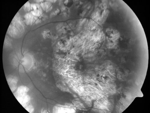 Macular and Peripheral Retinal Scarring from Diabetic Laser Done 25 years previously
72-year-old man had macular and peripheral laser done in the past(1980's)(25 years ago).  His vision, although limited, seems about stable to him.  He is diabetic for 30 years. OD is 20/160, OS  is 20/160.
