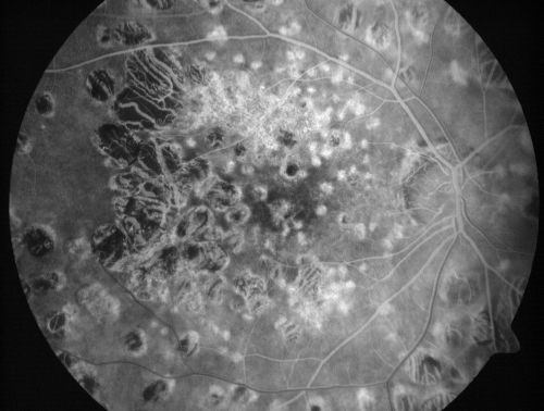 Macular and Peripheral Retinal Scarring from Diabetic Laser Done 25 years previously
72-year-old man had macular and peripheral laser done in the past(1980's)(25 years ago).  His vision, although limited, seems about stable to him.  He is diabetic for 30 years. OD is 20/160, OS  is 20/160.

