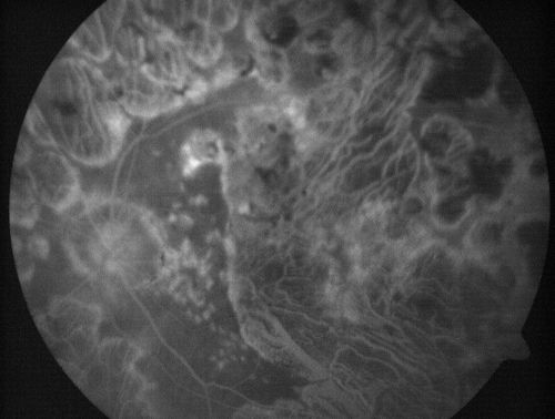 Macular Atrophy - Macular Degeneration and Previous Diabetic Macular Laser 72 Year Old Man
72-year-old man has age-related macular degeneration who had macular and peripheral laser done 30 years ago for diabetic retinopathy.  He has developed worsening macular atrophy in both eyes
