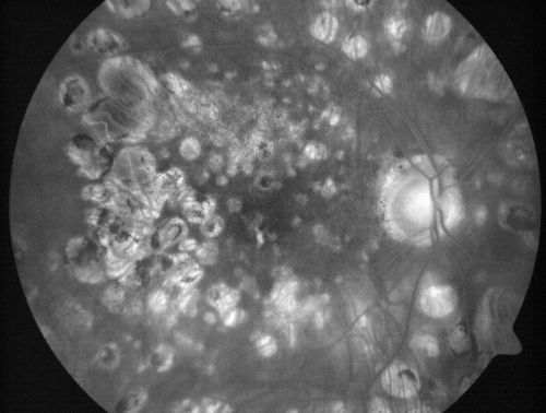 Macular Atrophy - Macular Degeneration and Previous Diabetic Macular Laser 72 Year Old Man
72-year-old man has age-related macular degeneration who had macular and peripheral laser done 30 years ago for diabetic retinopathy.  He has developed worsening macular atrophy in both eyes
