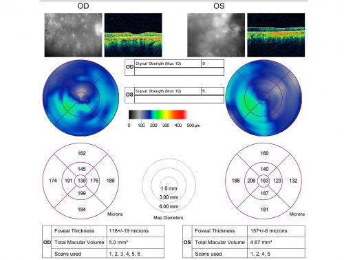 Macular Atrophy - Macular Degeneration and Previous Diabetic Macular Laser 72 Year Old Man
72-year-old man has age-related macular degeneration who had macular and peripheral laser done 30 years ago for diabetic retinopathy.  He has developed worsening macular atrophy in both eyes
