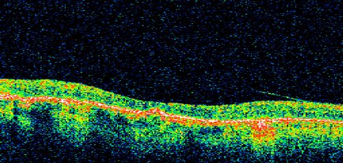 Macular and Peripheral Retinal Scarring from Diabetic Laser Done 25 years previously
72-year-old man had macular and peripheral laser done in the past(1980's)(25 years ago).  His vision, although limited, seems about stable to him.  He is diabetic for 30 years. OD is 20/160, OS  is 20/160.

