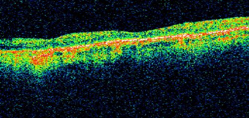Macular and Peripheral Retinal Scarring from Diabetic Laser Done 25 years previously
72-year-old man had macular and peripheral laser done in the past(1980's)(25 years ago).  His vision, although limited, seems about stable to him.  He is diabetic for 30 years. OD is 20/160, OS  is 20/160.
