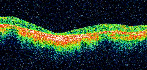 Macular Atrophy - Macular Degeneration and Previous Diabetic Macular Laser 72 Year Old Man
72-year-old man has age-related macular degeneration who had macular and peripheral laser done 30 years ago for diabetic retinopathy.  He has developed worsening macular atrophy in both eyes
