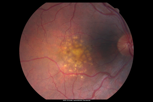 Drusen Maculopathy - Confluent Subfoveal Soft Hydrophobic Drusen - Yellow Drusen in the Center of the Macula
73-year-old woman. She is diabetic for thirteen years.  She is also on Coumadin for her heart disease.  

VISUAL ACUITY:  OD 20/25, OS 20/50.  
Keywords: soft drusen;amd;confluent drusen;dry;vitelliform