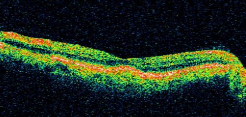 Drusen Maculopathy - Confluent Subfoveal Soft Hydrophobic Drusen - AMD OU- OCT Line Scan Shows Thickening Under Retina with Retinal Thinning
73-year-old woman. She is diabetic for thirteen years.  She is also on Coumadin for her heart disease.  

VISUAL ACUITY:  OD 20/25, OS 20/50.  
Keywords: soft drusen;amd;confluent drusen;dry;vitelliform
