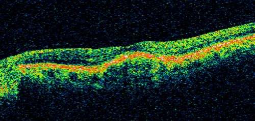 Drusen Maculopathy - Confluent Subfoveal Soft Hydrophobic Drusen - OCT Line Scan Shows Thickening Under Retina with Retinal Thinning
73-year-old woman. She is diabetic for thirteen years.  She is also on Coumadin for her heart disease.  

VISUAL ACUITY:  OD 20/25, OS 20/50.  
Keywords: soft drusen;amd;confluent drusen;dry;vitelliform