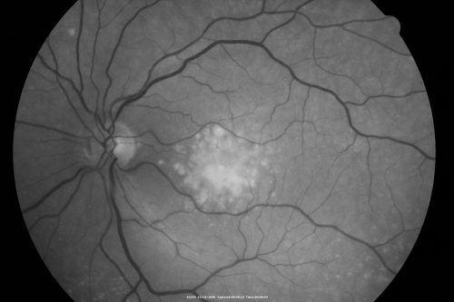 Drusen Maculopathy - Confluent Subfoveal Soft Hydrophobic Drusen - Red Free Image shows Confluent Drusen 
73-year-old woman. She is diabetic for thirteen years.  She is also on Coumadin for her heart disease.  

VISUAL ACUITY:  OD 20/25, OS 20/50.  
Schlüsselwörter: soft drusen;amd;confluent drusen;dry;vitelliform