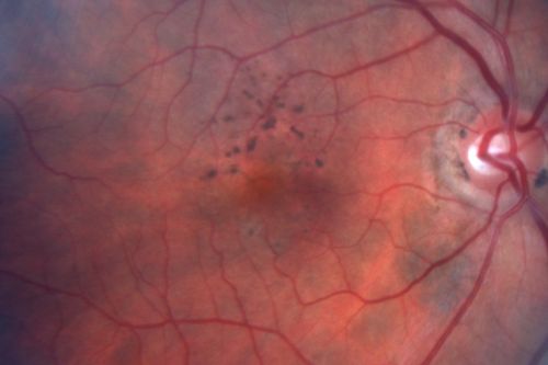 Hyperpigmentation of the Retinal Pigment Epithelium Right Eye (Treated wet AMD OS)
85-year-old man has wet age-related macular degeneration in the left eye treated for one year most recently one year ago. OD is 20/30, OS is 20/60
