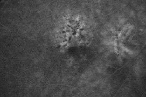 Hyperpigmentation of the Retinal Pigment Epithelium Right Eye (Treated wet AMD OS)
85-year-old man has wet age-related macular degeneration in the left eye treated for one year most recently one year ago. OD is 20/30, OS is 20/60
