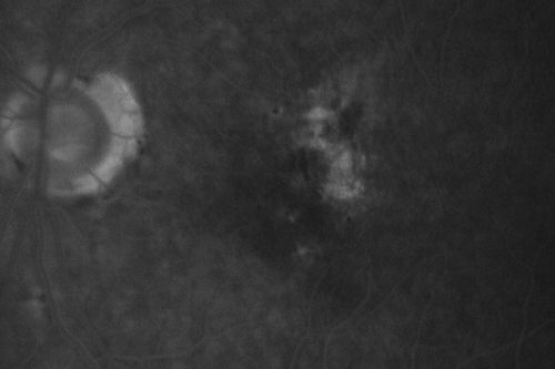 Hyperpigmentation of the Retinal Pigment Epithelium Right Eye (Treated wet AMD OS)
85-year-old man has wet age-related macular degeneration in the left eye treated for one year most recently one year ago. OD is 20/30, OS is 20/60
