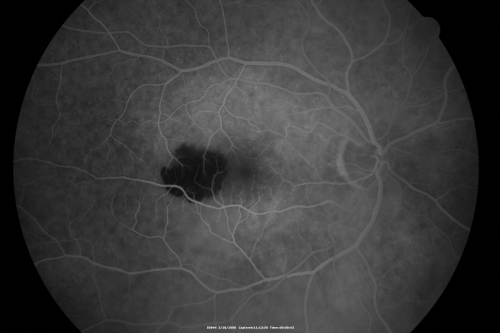 Wet AMD Small New Hemorrhage - Valsalva
79-year-old  two weeks ago he was having difficulty seeing out of the right eye. When he covered his left eye things were distorted  OD 20/50
Keywords: hemorrhage;amd;wet;valsalva