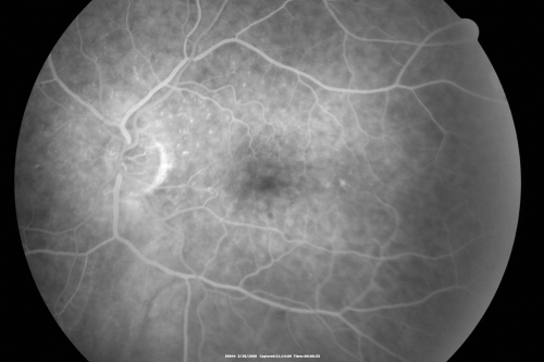 Wet AMD Small New Hemorrhage - Valsalva
79-year-old  two weeks ago he was having difficulty seeing out of the right eye. When he covered his left eye things were distorted  OD 20/50
Schlüsselwörter: hemorrhage;amd;wet;valsalva