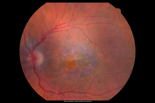 Concentric Geograophic Atrophy - Age-related Macular Degeneration - Charles Bonnet Syndrome - Bulls Eye
88-year-old woman has age-related with vision gradually declining over the last year.  She sees spots in her vision, like red spots and dark spots and she even notices during the daytime, for example when she was looking at her minister, it looked like there were little flowering pots coming out of his head.  

VISUAL ACUITY:  OD 20/200,  OS 20/400.
