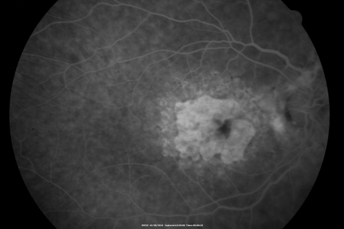 Concentric Geograophic Atrophy - Age-related Macular Degeneration - Charles Bonnet Syndrome - Bulls Eye
88-year-old woman has age-related with vision gradually declining over the last year.  She sees spots in her vision, like red spots and dark spots and she even notices during the daytime, for example when she was looking at her minister, it looked like there were little flowering pots coming out of his head.  

VISUAL ACUITY:  OD 20/200,  OS 20/400.
