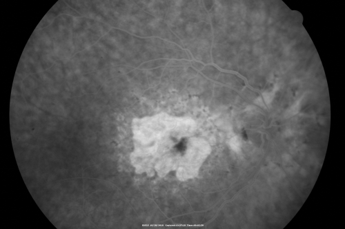 Concentric Geograophic Atrophy - Age-related Macular Degeneration - Charles Bonnet Syndrome - Bulls Eye
88-year-old woman has age-related with vision gradually declining over the last year.  She sees spots in her vision, like red spots and dark spots and she even notices during the daytime, for example when she was looking at her minister, it looked like there were little flowering pots coming out of his head.  

VISUAL ACUITY:  OD 20/200,  OS 20/400.
