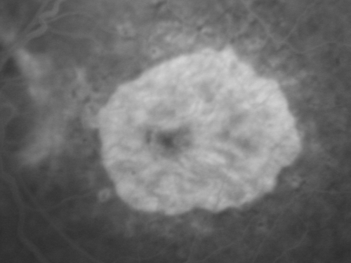 Concentric Geograophic Atrophy - Age-related Macular Degeneration - Charles Bonnet Syndrome - Bulls Eye
88-year-old woman has age-related with vision gradually declining over the last year.  She sees spots in her vision, like red spots and dark spots and she even notices during the daytime, for example when she was looking at her minister, it looked like there were little flowering pots coming out of his head.  

VISUAL ACUITY:  OD 20/200,  OS 20/400.
