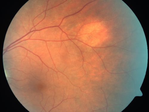 Amelanotic Nevus Initial Visit
