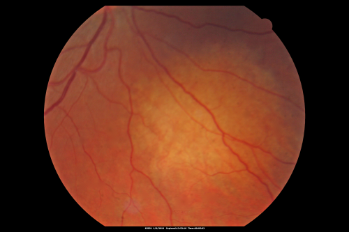 Amelanotic Choroidal Nevus 
45-year-old man   OD 20/20,  OS 20/20.  5x5 mm flat, yellow choroidal lesion just inferonasal to the optic nerve, two disc-diameters from the nerve with scalloped edges.   It looks like a confluent drusen, but it is not elevated. 
