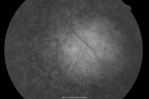 Amelanotic Choroidal Nevus 
45-year-old man   OD 20/20,  OS 20/20.  5x5 mm flat, yellow choroidal lesion just inferonasal to the optic nerve, two disc-diameters from the nerve with scalloped edges.   It looks like a confluent drusen, but it is not elevated. 
