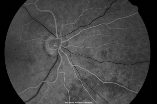 Amelanotic Choroidal Nevus 
45-year-old man   OD 20/20,  OS 20/20.  5x5 mm flat, yellow choroidal lesion just inferonasal to the optic nerve, two disc-diameters from the nerve with scalloped edges.   It looks like a confluent drusen, but it is not elevated. 
